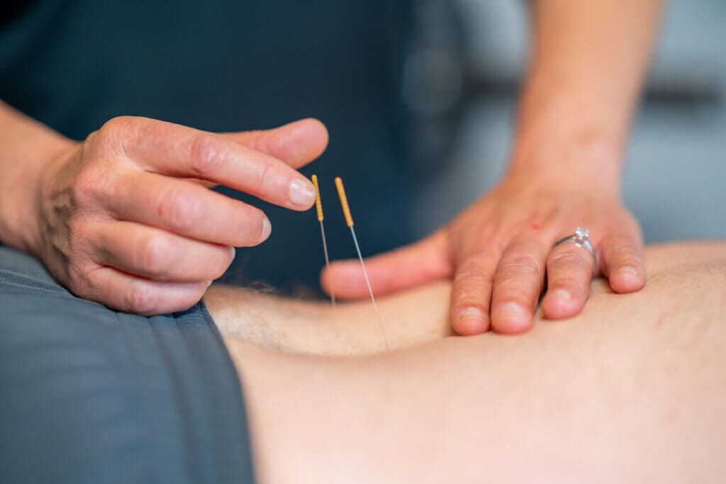 Dry Needling